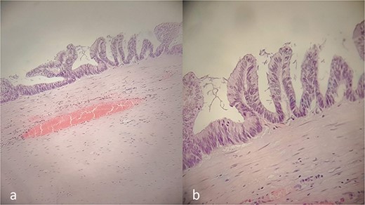 Histopathology report. Villous proliferation of mucinous epithelial cells; showing elongated nuclei and low-grade nuclear atypia (a, b).
