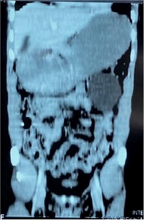 Coronal CT image of the inflamed appendix and mesenteric cyst.