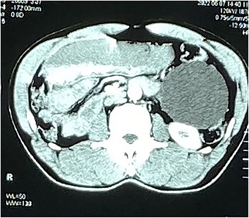 Axial CT image of the mesenteric cyst.