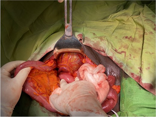 Intraoperative mesenteric cyst located in the descendent mesocolon with left colic vessels overrunning it.
