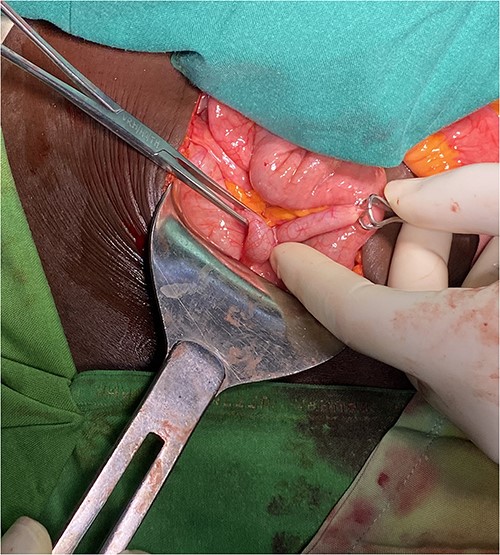Inflamed appendix with adhesions angulating the distal part of it.