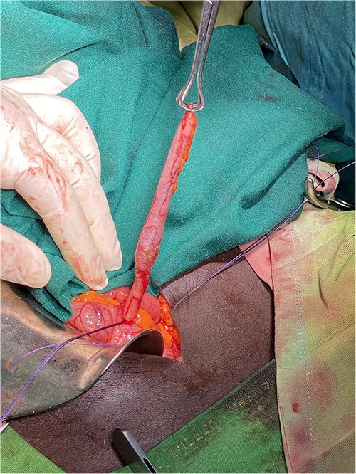 Inflamed and distended appendix from its distal third after being released from adhesions and mesoappendix.