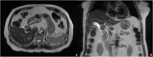 Magnetic resonance elastography showing 3 cm porta hepatis mass causing mild intrahepatic biliary ductal dilation; (A) axial view, (B) coronal view.