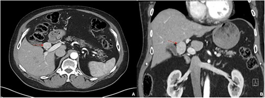 A multi-phase CT showing a 2.8 cm hyperenhancing nodular mass in the liver hilum; (A) axial view, (B) coronal view.