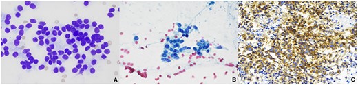 FNA of extrahepatic biliary mass revealed a well-differentiated NET; (A) cluster of monotonous cells in rosettes, Diff-Quick, 600x; (B) uniform round to oval cells with salt and pepper chromatin and moderate amounts of granular cytoplasm, Papanicolaou, 600x; (C) tumor cells were diffusely positive for synaptophysin, 400x.
