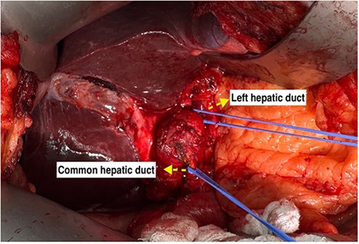 Extrahepatic tumor encasing the common hepatic duct and extending to the right and left hepatic ducts.