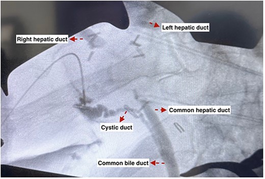 An intraoperative cholangiogram showing tumor involvement of the common hepatic duct up to the right and left hepatic ducts.