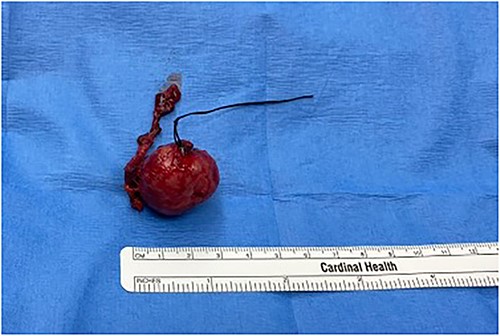 Gross examination of the extrahepatic NET.