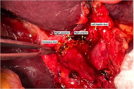 Three right bile duct openings (anterior, posterior and accessory).