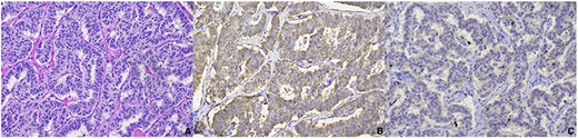 Microscopic examination of extrahepatic biliary mass resection demonstrated a well-differentiated NET; (A) monotonous tumor cells arranged in trabecular pattern, hematoxylin–eosin; (B) tumor cells were diffusely positive for chromogranin; (C) tumor cells showed Ki-67 proliferation activity of 1%; all photographs at 200x.