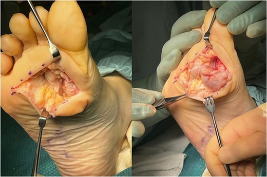 Large, poorly circumscribed nodule, difficult to separate from surrounding soft tissues.