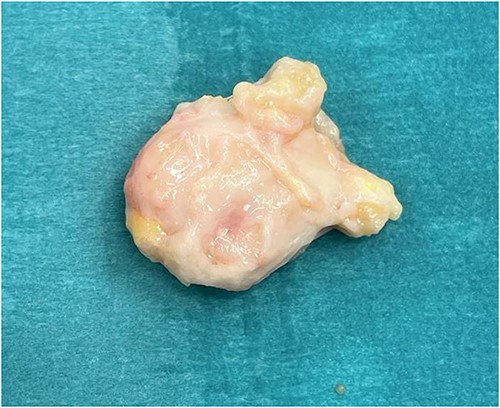 Excised mass was excised with soft tissue pedicles, measuring ~4.0 cm × 3.0 cm.