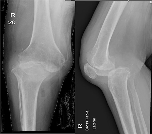 Anteroposterior and lateral views of the knee at second presentation.