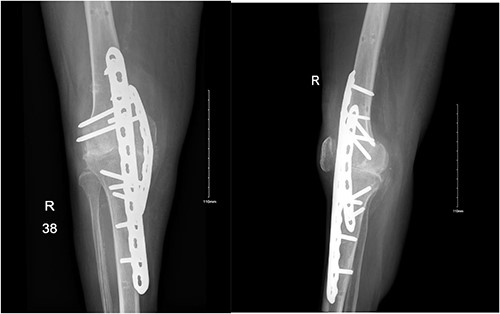 Anteroposterior and lateral views of the knee following arthrodesis.