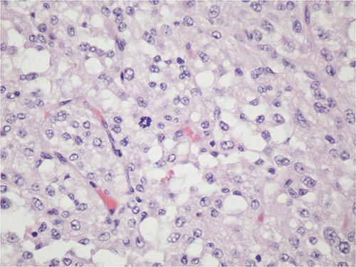 The tumoral relationship with colonic muscularis propria, 20X H&E.