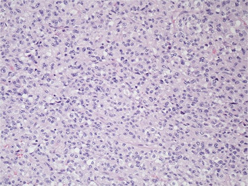 The tumor is composed of relatively monotonous cells with ample eosinophilic cytoplasm arranged in sheets; nuclei show vesicular chromatin with prominent nucleoli and also show a range of cytologic atypia; there is no characteristic vascular pattern, 100X, H&E.