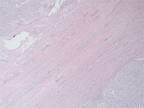 Higher power of Fig. 2—one can occasionally find mitotic figures (center field), 400X, H&E.