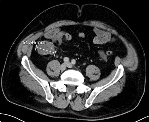 Axial CT abdomen with contrast demonstrating an appendiceal mass of maximum diameter 51.96 mm.