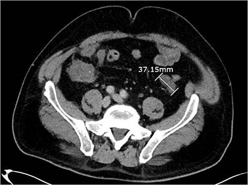 Axial CT abdomen with contrast demonstrating a peritoneal deposit posterior to the descending colon in the left iliac fossa, measuring 37.15 mm.