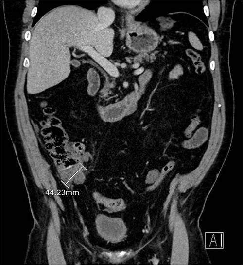 Three-month post-chemotherapy coronal CT abdomen and pelvis with contrast demonstrating a reduction in size of the primary appendiceal mass to 44.23 mm.