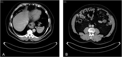 (A) axial CT abdomen demonstrating a serosal deposit measuring 27.76 mm. (B) Axial CT abdomen demonstrating a peritoneal abdominal wall deposit measuring 39.72 mm.