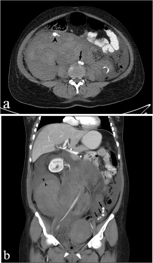 IV and PO contrast-enhanced CT in portal phase shows a massive heterogeneous hematoma in the pelvic region, dominantly in the right lower quadrant. (a) An axial section at the level of abdominal aortic bifurcation, shows the dilated and anteriorly displaced right ovarian artery (arrowhead), indicating an aneurysm—its size is comparable to the common iliac artery (arrow). (b) A coronal reconstruction of the retroperitoneum demonstrates the extent of hematoma. The left ovarian artery manifests multiple aneurysms (arrows), and the obvious border between two regions of hematoma with different densities (paired arrowheads) shows separate bleeding episodes.