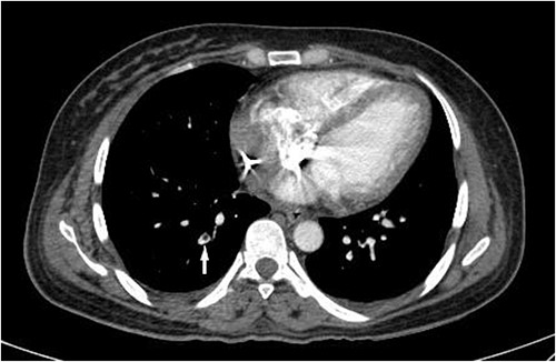 CT pulmonary angiogram on the third day of hospital admission shows a filling defect in a subsegmental branch of the right posterior pulmonary artery (white arrow), compatible with a PE.