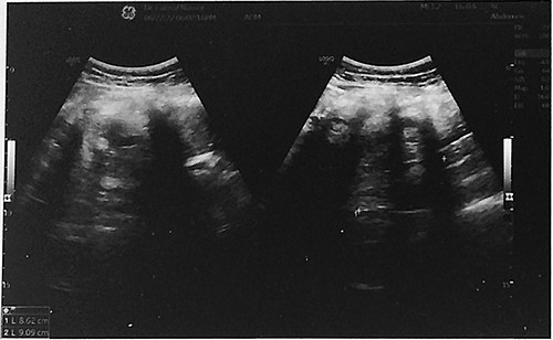 Abdominal ultrasound showed a large solid cystic mass measuring 8.6 cm × 9.1 cm in size in the right adnexal region.