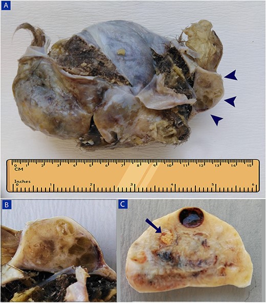 A gross image of the right adnexal mass (A and B) and left ovary (C). (A) A large cystic teratoma, filled with hair shafts and greasy brown material, with a well-defined nodule measuring 4 cm × 3 cm × 2 cm, is adherent to the teratoma (arrowheads). (B) The nodule’s cut surface is tan with a glairy meaty appearance, and multiple small cysts containing yellow gelatinous material are seen. (C) A small solid yellow nodular lesion, about 1 cm in maximum dimension with clear borders, is noted in the left ovary (arrow).
