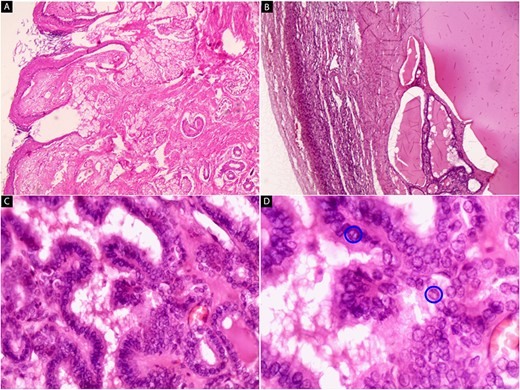 Hematoxylin and eosin stain (A–D). Microscopic images of the right adnexal mass. (A) Cyst wall lined by stratified squamous epithelium with mature skin appendages (hair follicles and sebaceous glands) and loose keratin flakes in the lumen (x40). (B) The ovarian cortex is on the left side of the image with residual thyroid tissue on the right side (x40). (C) Well-developed papillae with epithelium composed of cuboidal cells are present (x200). (D) The nuclei are ovoid, crowded with ground glass appearance (‘Orphan Annie’ eye), and have grooves (blue circles) (x400).