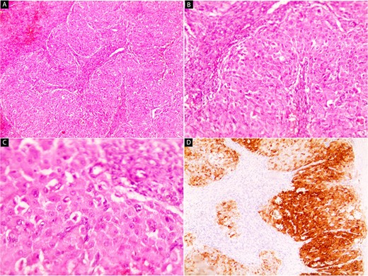 Hematoxylin and eosin stain (A–C) and IHC (D). Microscopic images of the left ovary. (A and B) Nests and islands of polygonal cells with abundant eosinophilic granular cytoplasm surrounded by ovarian stroma (x40 and x100) (C) Small, rounded, centrally placed nuclei are seen (x200). (D) Tumor cells are markedly positive for inhibin (x100).