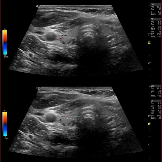 Ultrasound neck showing normal thyroid gland and no abnormal parathyroid.