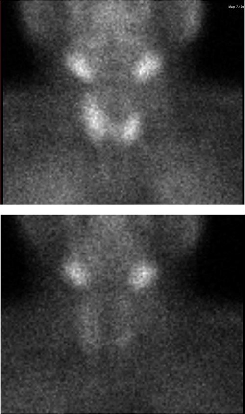 Sestambi scan showing no parathyroid uptake.
