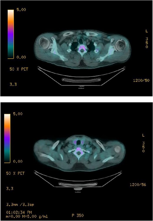 F-18 FCH PET/CT shows negative.
