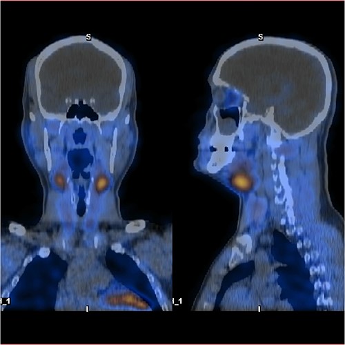 F-18 FCH PET/CT shows negative uptake.