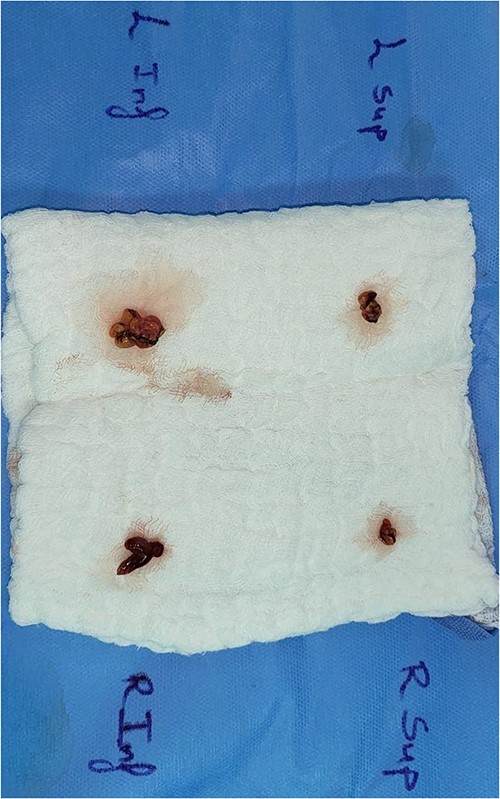Parathyroid glands after resection.