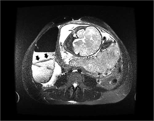Axial image of an abdominal MRI on a 36-week pregnant patient with a dilated cecum anteriorly displaced to the ascending colon. Arrows mark the point of inflection.