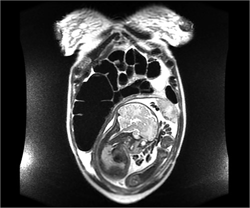Coronal image of the same MRI showing a dilated cecum displaced superiorly, consistent with a cecal bascule.