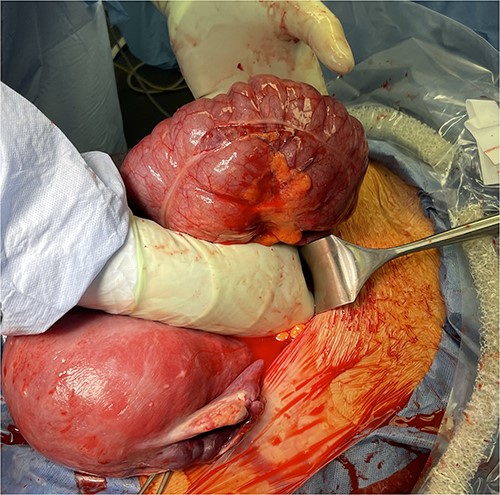 Dilated and deserosalized cecum after reduction of the cecal bascule. The uterus immediately after cesarean section lies to the lower left.