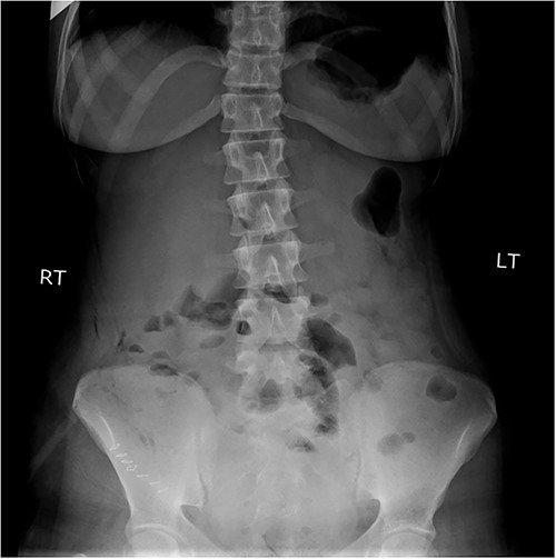Plain abdominal X-ray demonstrated air-fluid levels of the small bowel.