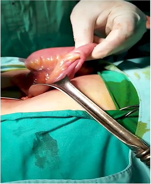 Intussuscepted portion of ileus attributed to inverted MD.