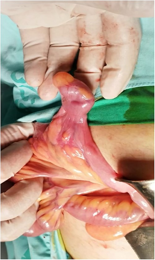 Intraoperative image of a free diverticulum located ~75 cm from the ileocecal valve.
