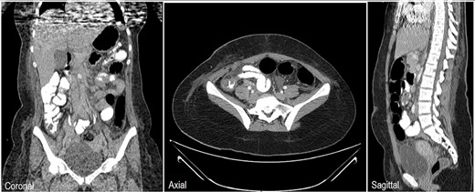 Chest, abdomen and pelvis CT scan with Oral & IV contrast postop Day 5 showed no contrast leak, no fistula and no obstruction at the site of surgery.