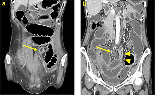 Computed tomography showed that dilated small intestine were positioned in the lateral space of the lifted sigmoid colostomy. (a) A caliber change of dilated intestine was found adjacent to the left side of the lifted colostomy (b). Arrows: the lifted sigmoid colostomy; arrowheads: a caliber change of the dilated intestine.