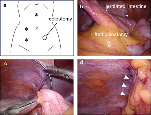 Laparoscopic surgery was performed using three ports (a). Small intestine had passed through a defect between the lifted sigmoid colon and abdominal wall in a cranial-to-caudal direction (b). The hernia orifice between the lifted sigmoid colon and lateral wall was closed using barbed suture (c and d). *: port placement; arrowheads; suture line of hernia orifice closure.
