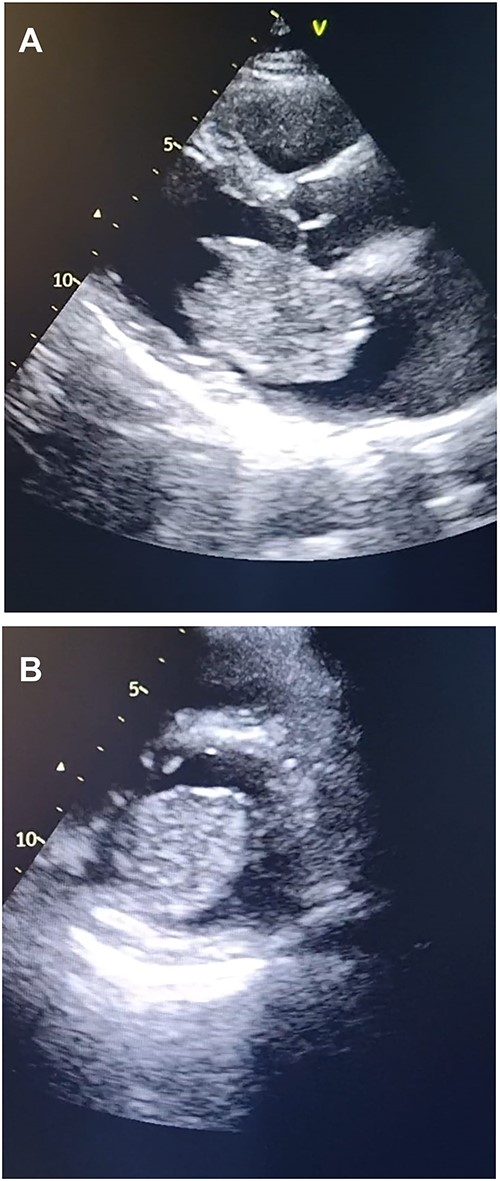 Transthoracic echocardiography. (A) Echocardiogram parasternal long-axis view (PLAX) view showing large homogenous mobile mass in LA. (B) Echocardiogram parasternal short-axis view (PSAX) view showing Left atrial mass protrusion through the Mitral valve during diastole.