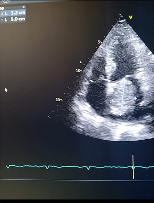 Transthoracic echocardiography. 2D measurements of the LA mass measuring 5 cm * 3.2 cm.