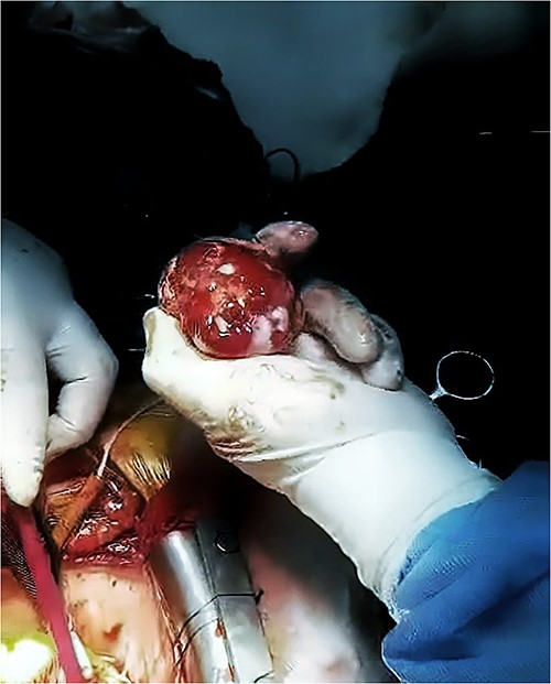 The LA mass after excision. The heterogeneous mass after being excised during open heart surgery.