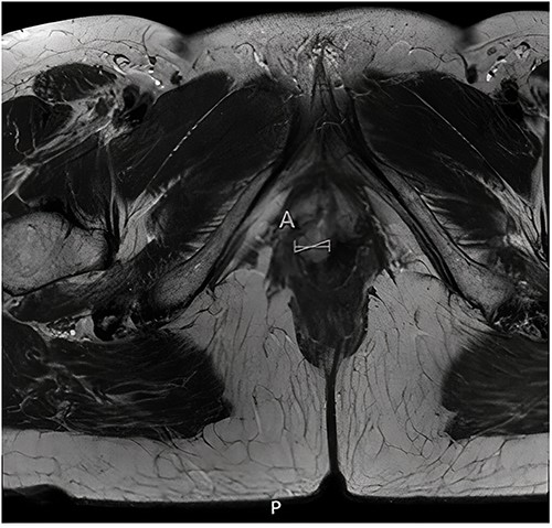 Axial view of diagnostic MRI-rectum with the solid tumour indicated with the linear mark ‘A’.