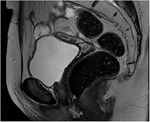 Sagittal view of diagnostic MRI-rectum with the solid tumour indicated with the linear mark ‘A’.
